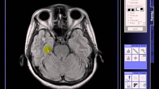 BRAIN MRI Multiple lacunar infarcts [upl. by Nawrocki]