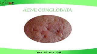 Acne Conglobata [upl. by Nauqat]