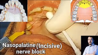 Local Anesthesia Nasopalatine Nerve block technique Maxillary anesthesia Techniques dentistry [upl. by Euk]