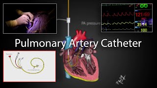 Pulmonary artery catheter SwanGanz Catheter placement and physiology [upl. by Atsocal359]