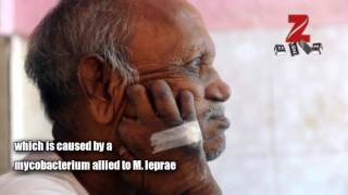 World Leprosy Day 2017 Why we need to step up the fight against this health issue [upl. by Nielsen]