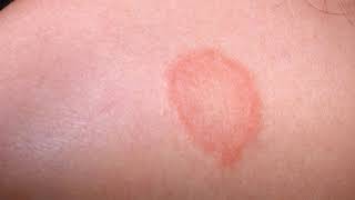 Difference Between Eczema and Ringworm [upl. by Keary]