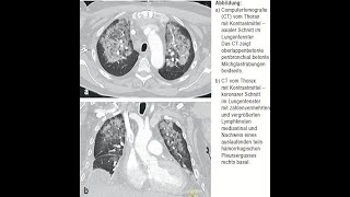 Daptomycin assoziierte eosinophile Pneumonitis [upl. by Hollah]