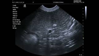 Ultrasound scan showing calcified nodule in the canine spleen [upl. by Yliab]