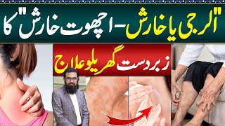 Scabies Home Treatment  Kharish Allergy Ka Ilaj  Psoriasis and Itching Treatment  Chambal Ka ilaj [upl. by Ogir]