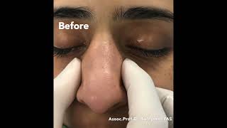 Wide Nose  Closed Atraumatic Rhinoplasty [upl. by Iana947]