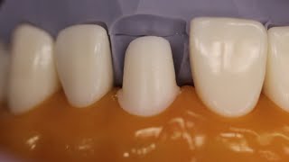 PFM Anterior Tooth Preparation [upl. by Shurlock871]