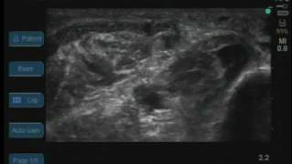 UltrasoundGuided Phenol Injection into the Tibial Nerve [upl. by Warms336]