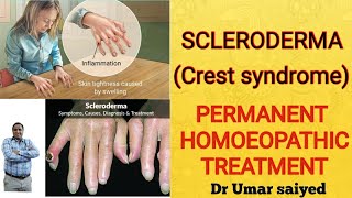 SCLERODERMA PERMANENT HOMOEOPATHIC TREATMENT [upl. by Levona]