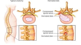 Back pain kamar Dard L4 L5 L5 S1 disc mein problem thi vah Dr AP GAUTAM physiotherapy se thik kardi [upl. by Trilby]