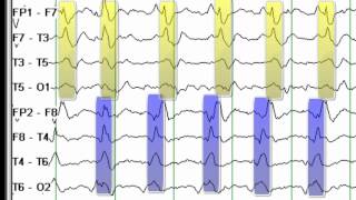 EEG Reading Rounds BIPLEDS [upl. by Ajak]