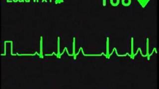 Nodal Trigeminy  ECG Simulator  Arrhythmia Simulator [upl. by Garmaise]