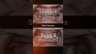 Braces for crooked teeth dentist orthodontist braces dentisty [upl. by Nevak938]