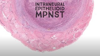 Intraneural epithelioid MPNST malignant peripheral nerve sheath tumorAustralasian Dermpath Case 12 [upl. by Sello]