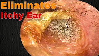 The Itching Stopped after Removing Earwax  Doctor Anh [upl. by Idelle]