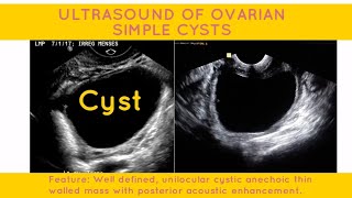 OVARIAN SIMPLE CYST ULTRASOUND REPORT PELVIC ULTRASOUND  ultrasound ultrasoundscans [upl. by Ydospahr481]