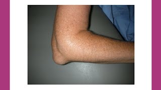 What is Olecranon Bursitis  shorts [upl. by Ermentrude]