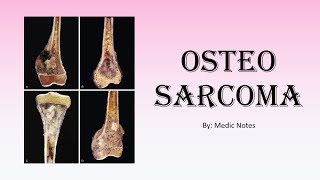 Ortho Osteosarcomabone cancer  causes xray findings signs amp symptoms treatment [upl. by Rexferd98]