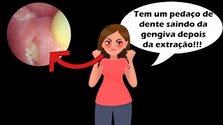 Pedaço de Dente Saindo da Gengiva Após Extração  Descubra o Que Fazer e Como Tratar o Problema [upl. by Camus973]