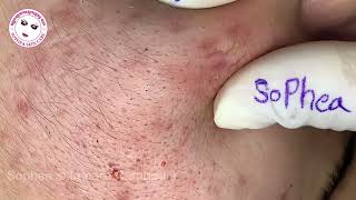 Acne facial removal treatment by Sopheaskincarecambodia 14th December 2023 [upl. by Nillad737]