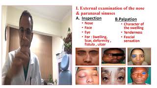 Nose amp sinus examination  ENT  4th grade  by Dr Mohamed Omar Gad [upl. by Stefanac]