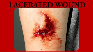 lacerated wound [upl. by Dihgirb495]