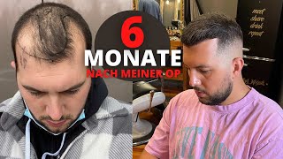 Haartransplantation Vorher Nachher  6 Monate nach der OP [upl. by Halueb]