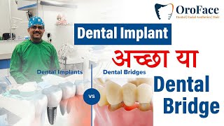 Dental Implant या Dental Bridge क्या है बेहतर [upl. by Oemac618]