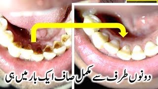 Teeth Whitening amp Try it Once And See The Result  2018 [upl. by Coltson74]