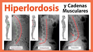 🔴 HIPERLORDOSIS y Cadenas Musculares Lumbago y Artrosis 👉 Son Claves el Diafragma y el Psoas [upl. by Helen]