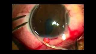 Man with Parasite Worm in Eye  Nematode Worms in Eyeball [upl. by Bone]