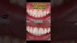 ❌ carillasdentales carillas carilladeresina resinadental diseñodesonrisa odontologia [upl. by Elroy]