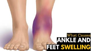 What Causes Ankles amp Feet Swelling  Diagnosis amp Treatment [upl. by Anpas]