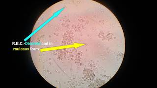 Stool analysisLab diagnosis of dysentery bacillary dysentery [upl. by Cutty311]