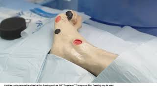 Application tips 3M™ VAC® Dressing Application Bridging Technique on Foot Wound [upl. by Dyer]