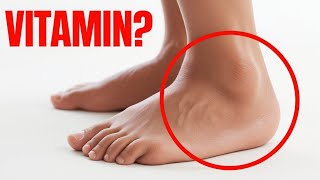 1 Vitamin to Eliminate Swelling in Feet and Legs [upl. by Terena]