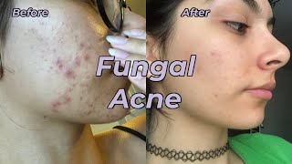 My Fungal Acne Journey [upl. by Leksehcey245]