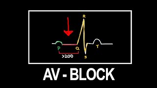 AV BLOCK einfache Merkhilfen [upl. by Bala]