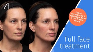 Full Face Dermal Fillers Treatment Demonstration by Dr Tristan Mehta [upl. by Garretson587]