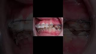 dentist dentalclinic trending shorts smile dentistry orthodontist trendshort bds yt [upl. by Einafets]