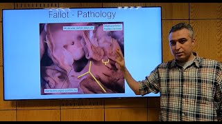 Fallot Tetralogy Part 1 En  Hatem Hosny [upl. by Meredith835]