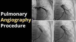 Pulmonary Angiography Procedure Angiogram Balloon Video [upl. by Sokim]