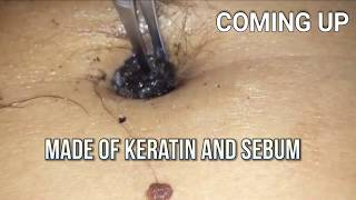 Navel Stone or Giant Belly Blackhead Bizarre Medical [upl. by Zebulen]