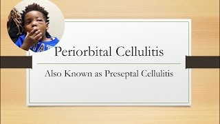 Periorbital Cellulitis Emergency [upl. by Malvino288]