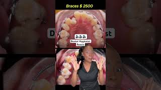 What an amazing braces transformation braces braceslife [upl. by Bev]