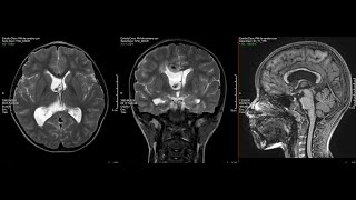 Tumor Ventricular Oligodendroglioma [upl. by Nhguahs]