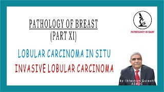 Lobular Carcinoma In Situ and Invasive Lobular Carcinoma by Dr Ihtesham Qureshi [upl. by Skippie91]