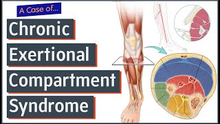 Chronic Exertional Compartment Syndrome [upl. by Colwen688]