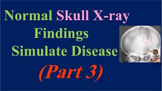 Normal Skull Xray Findings Simulate Disease part 3 Pacchionian Granulation amp Wormian bones [upl. by Allerus]