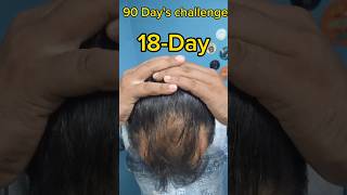 18 day used aadivasi herbal hair oil results hairfall adivasihairoil adivasihairoilreview [upl. by Acinaj]